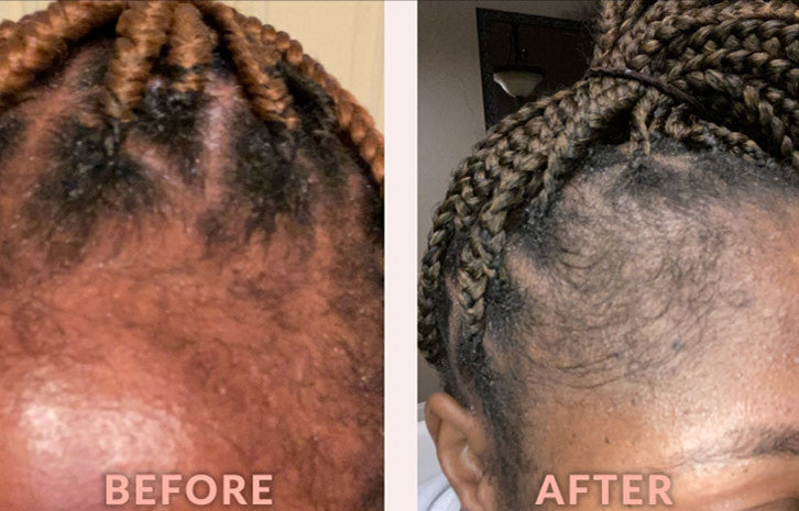 Scalp Care Edge & Temple Strengthening Oil